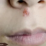Herpes Inside Nose?Symptoms, Remedies & Care Tips