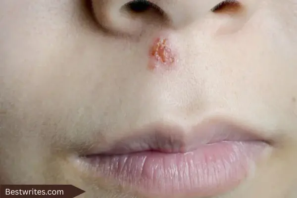 Herpes inside nose