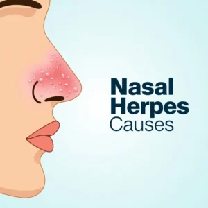 nasal herpes Cause