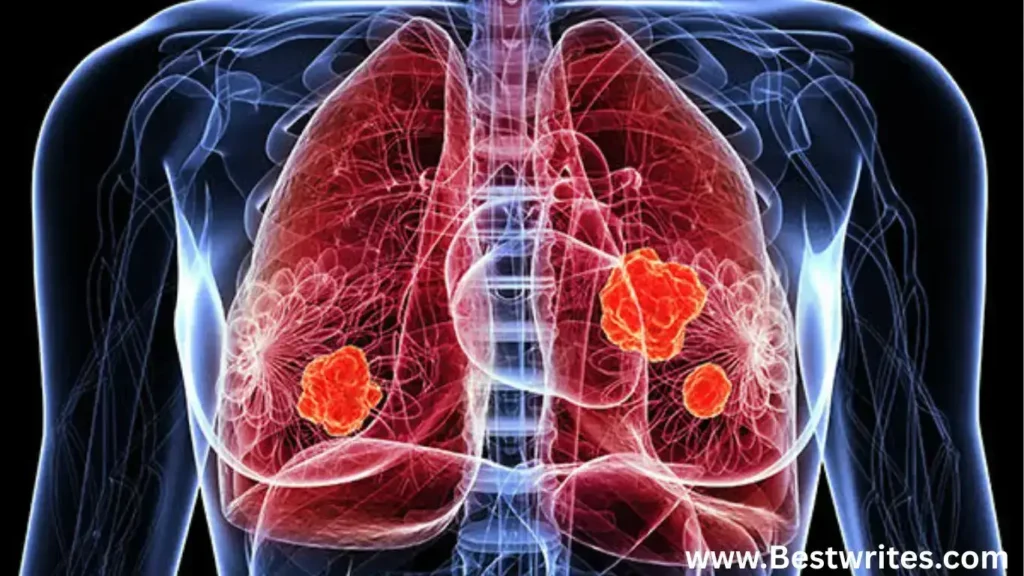 screening for lung cancer icd 10