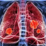 Lung Cancer Screening & ICD-10 Codes Explained| Bestwrites