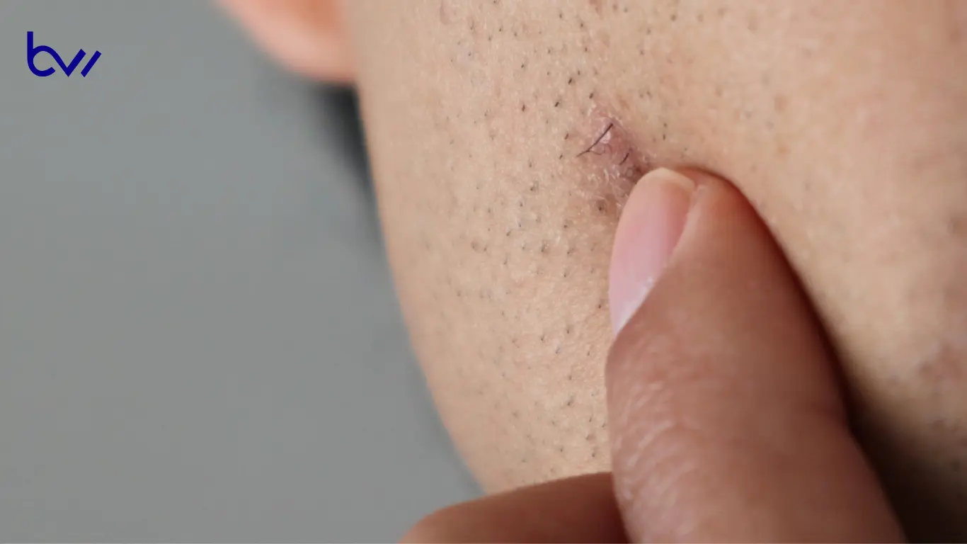 Symptoms and Complications of Ingrown Hairs